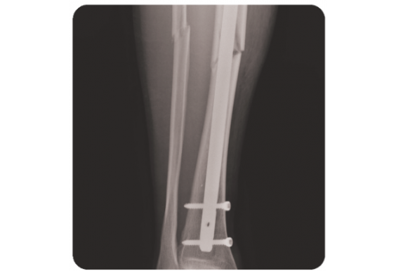 Chấn thương chân và đầu gối